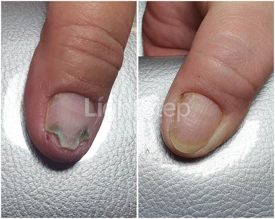 Fungal nail treatment before