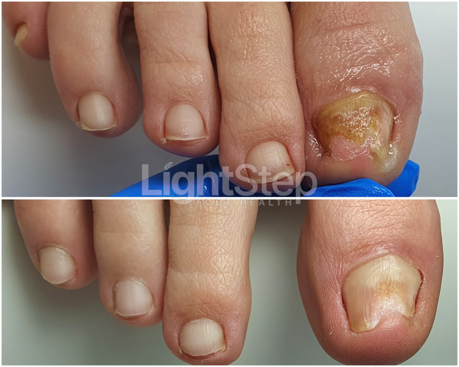 Fungal nail treatment before